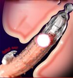 Bao cao su đôn gai quai rung hai đầu CHB13K